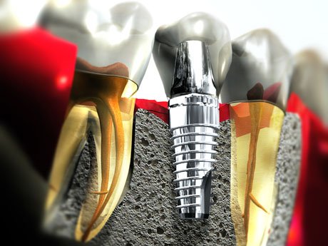Ilustração de implante dentário e prótese