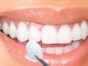 Ilustração de laminados cerâmicos dentários